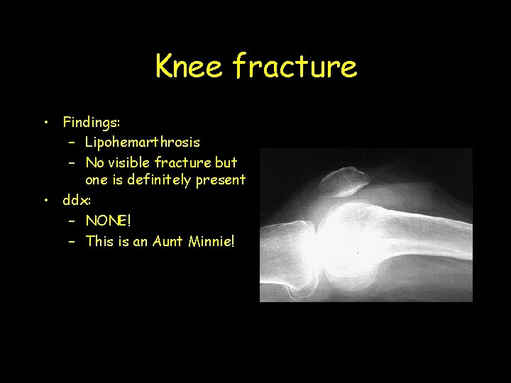 Knee fracture • Findings: – Lipohemarthrosis – No visible fracture but one is definitely
