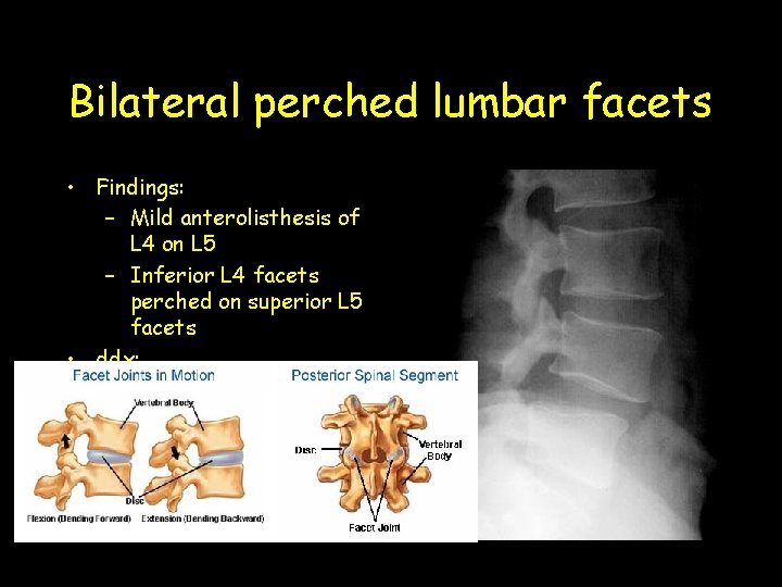 Bilateral perched lumbar facets • Findings: – Mild anterolisthesis of L 4 on L