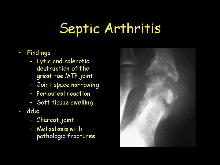 Septic Arthritis • Findings: – Lytic and sclerotic destruction of the great toe MTP