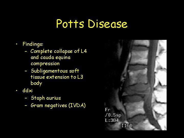 Potts Disease • Findings: – Complete collapse of L 4 and cauda equina compression