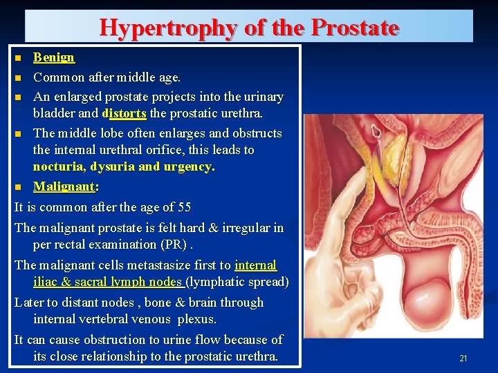 Hypertrophy of the Prostate Benign n Common after middle age. n An enlarged prostate