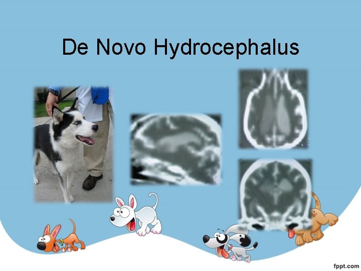 De Novo Hydrocephalus 