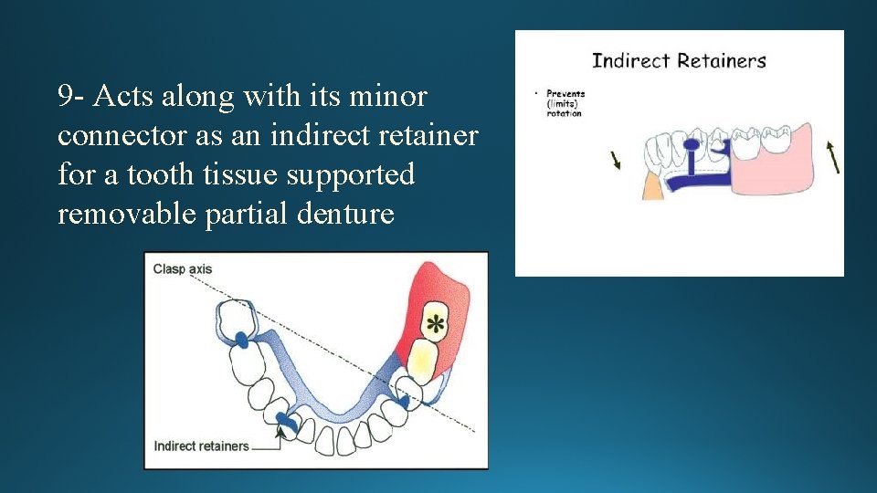 9 - Acts along with its minor connector as an indirect retainer for a