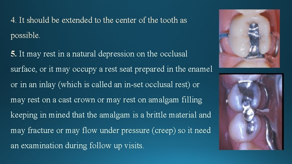 4. It should be extended to the center of the tooth as possible. 5.