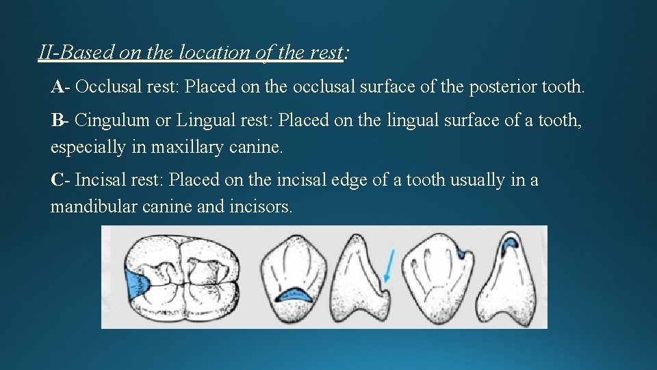 II-Based on the location of the rest: A- Occlusal rest: Placed on the occlusal