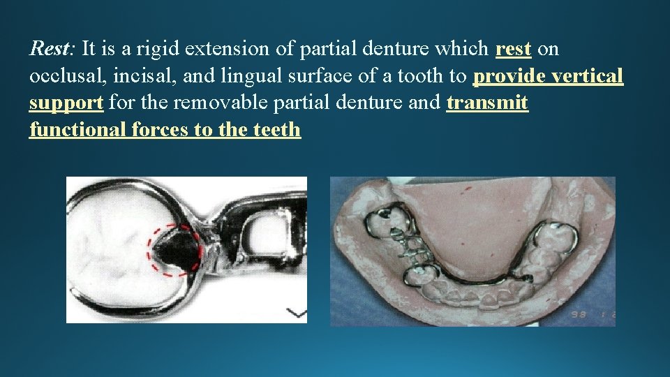Rest: It is a rigid extension of partial denture which rest on occlusal, incisal,
