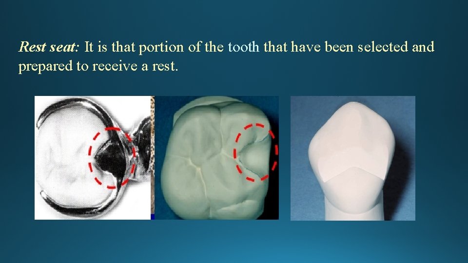 Rest seat: It is that portion of the tooth that have been selected and