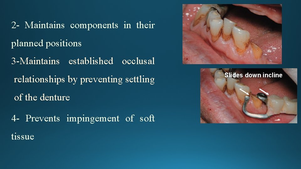 2 - Maintains components in their planned positions 3 -Maintains established occlusal relationships by