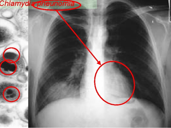 Chlamydia pneunomia Human Respiratory Tract 