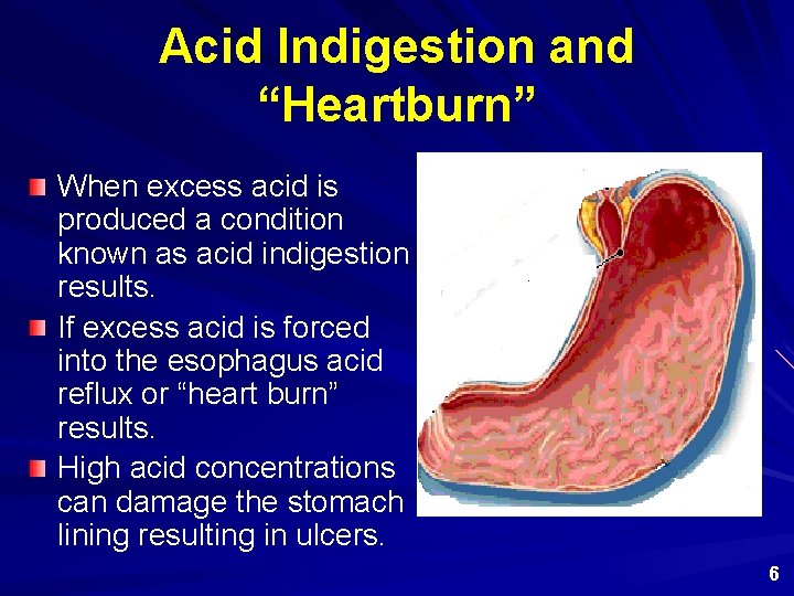 Acid Indigestion and “Heartburn” When excess acid is produced a condition known as acid
