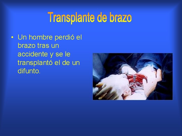  • Un hombre perdió el brazo tras un accidente y se le transplantó