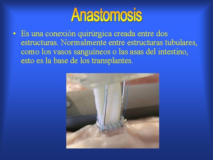  • Es una conexión quirúrgica creada entre dos estructuras. Normalmente entre estructuras tubulares,