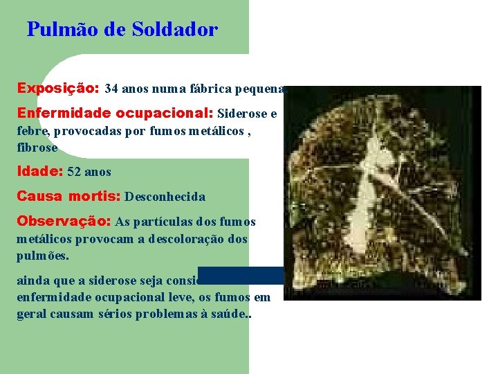 Pulmão de Soldador Exposição: 34 anos numa fábrica pequena. Enfermidade ocupacional: Siderose e febre,