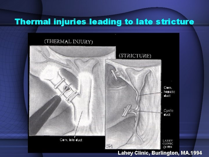 Thermal injuries leading to late stricture Lahey Clinic, Burlington, MA. 1994 