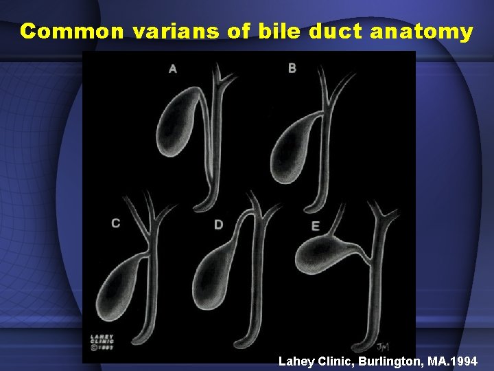 Common varians of bile duct anatomy Lahey Clinic, Burlington, MA. 1994 