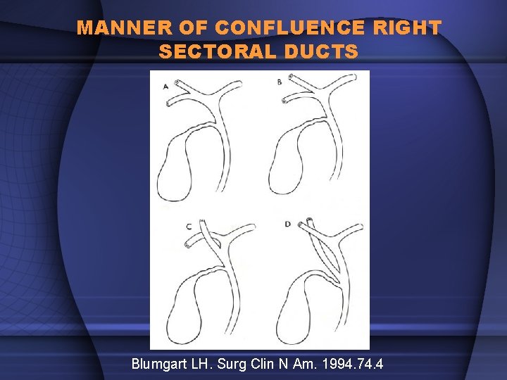 MANNER OF CONFLUENCE RIGHT SECTORAL DUCTS Blumgart LH. Surg Clin N Am. 1994. 74.