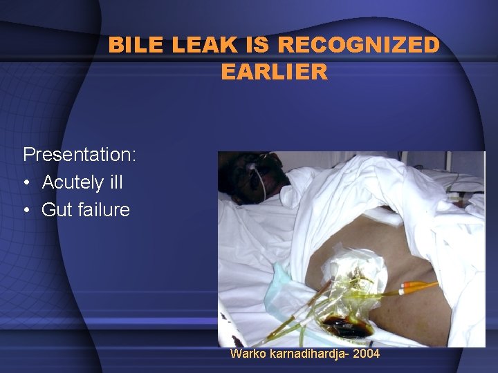 BILE LEAK IS RECOGNIZED EARLIER Presentation: • Acutely ill • Gut failure Warko karnadihardja-