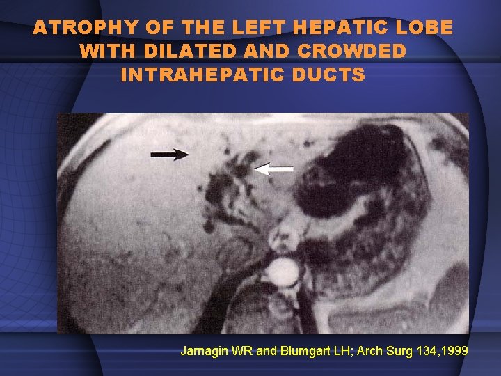 ATROPHY OF THE LEFT HEPATIC LOBE WITH DILATED AND CROWDED INTRAHEPATIC DUCTS Jarnagin WR