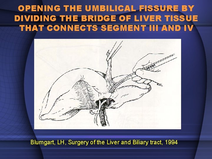 OPENING THE UMBILICAL FISSURE BY DIVIDING THE BRIDGE OF LIVER TISSUE THAT CONNECTS SEGMENT