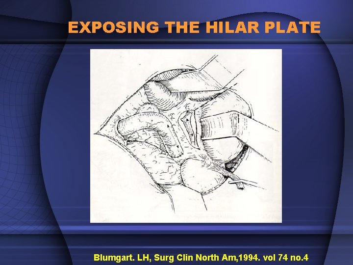 EXPOSING THE HILAR PLATE Blumgart. LH, Surg Clin North Am, 1994. vol 74 no.