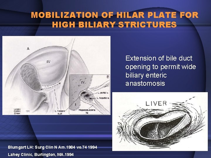 MOBILIZATION OF HILAR PLATE FOR HIGH BILIARY STRICTURES Extension of bile duct opening to