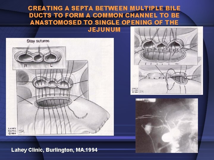 CREATING A SEPTA BETWEEN MULTIPLE BILE DUCTS TO FORM A COMMON CHANNEL TO BE