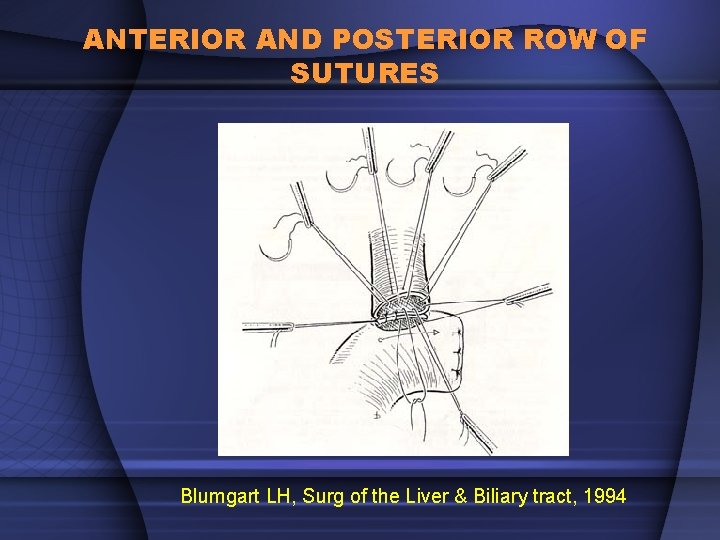 ANTERIOR AND POSTERIOR ROW OF SUTURES Blumgart LH, Surg of the Liver & Biliary