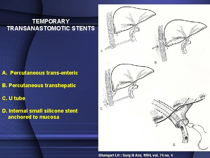 TEMPORARY TRANSANASTOMOTIC STENTS A. Percutaneous trans-enteric B. Percutaneous transhepatic C. U tube D. Internal