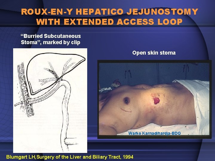ROUX-EN-Y HEPATICO JEJUNOSTOMY WITH EXTENDED ACCESS LOOP “Burried Subcutaneous Stoma”, marked by clip Open