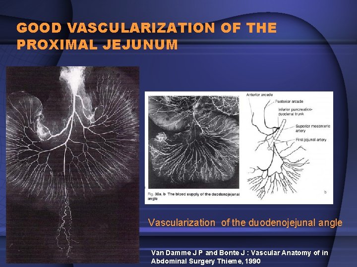 GOOD VASCULARIZATION OF THE PROXIMAL JEJUNUM Vascularization of the duodenojejunal angle Van Damme J