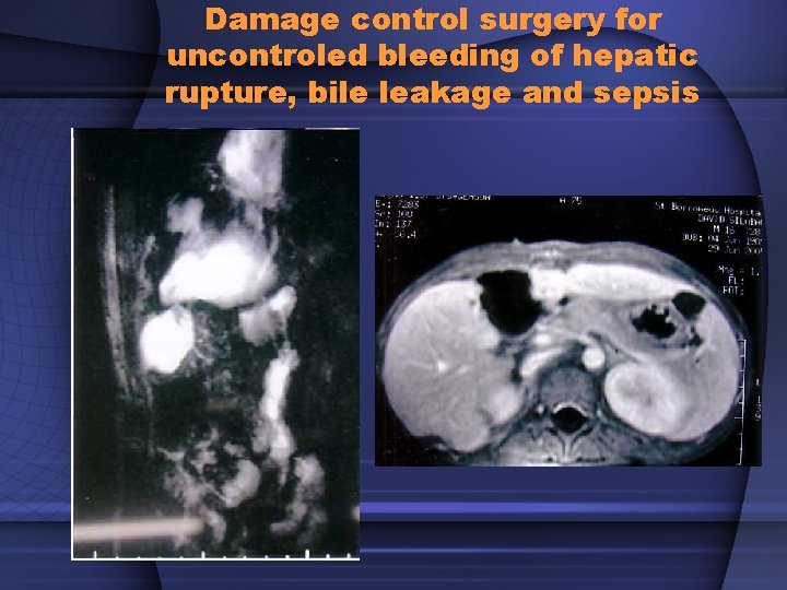 Damage control surgery for uncontroled bleeding of hepatic rupture, bile leakage and sepsis 