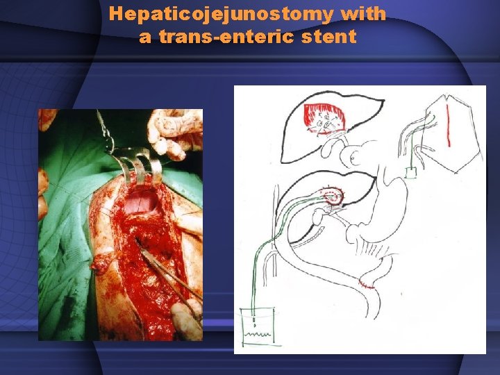 Hepaticojejunostomy with a trans-enteric stent 