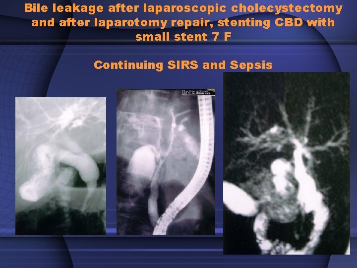 Bile leakage after laparoscopic cholecystectomy and after laparotomy repair, stenting CBD with small stent