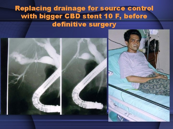 Replacing drainage for source control with bigger CBD stent 10 F, before definitive surgery