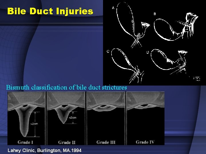 Bile Duct Injuries Bismuth classification of bile duct strictures Lahey Clinic, Burlington, MA. 1994