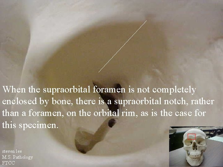 When the supraorbital foramen is not completely enclosed by bone, there is a supraorbital