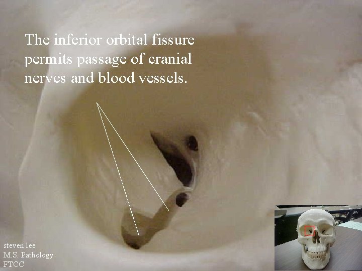 The inferior orbital fissure permits passage of cranial nerves and blood vessels. steven lee