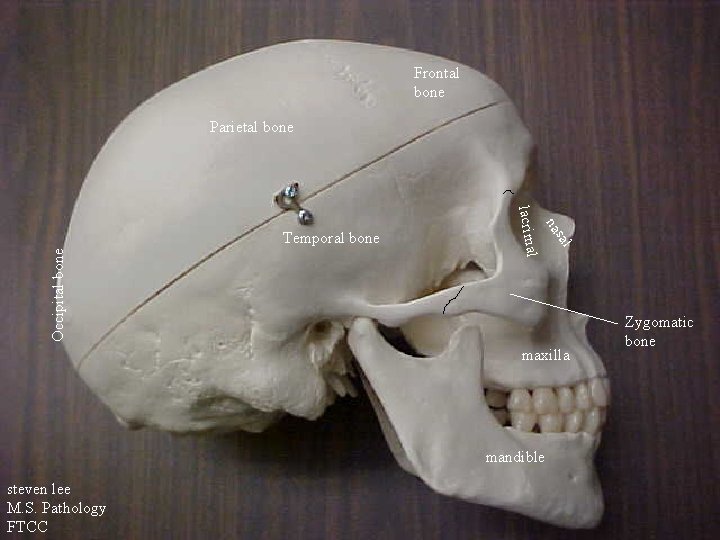 Frontal bone Parietal bone Occipital bone l sa na l lacrima Temporal bone maxilla