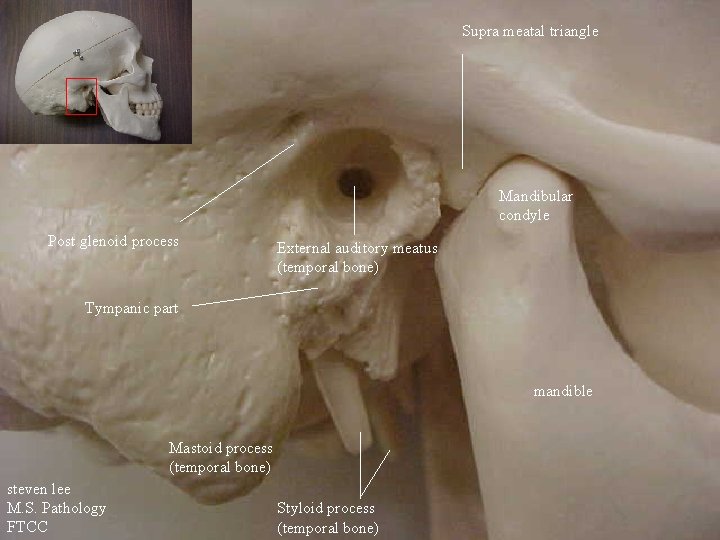 Supra meatal triangle Mandibular condyle Post glenoid process External auditory meatus (temporal bone) Tympanic