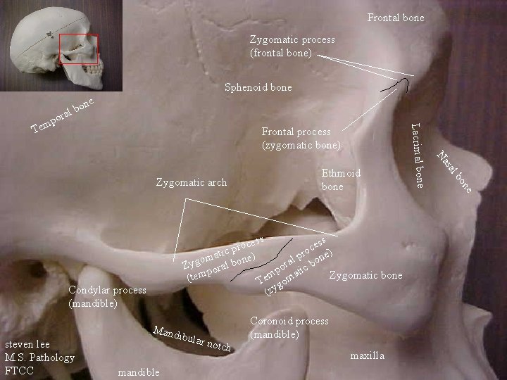 Frontal bone Zygomatic process (frontal bone) Sphenoid bone ne o b al Frontal process
