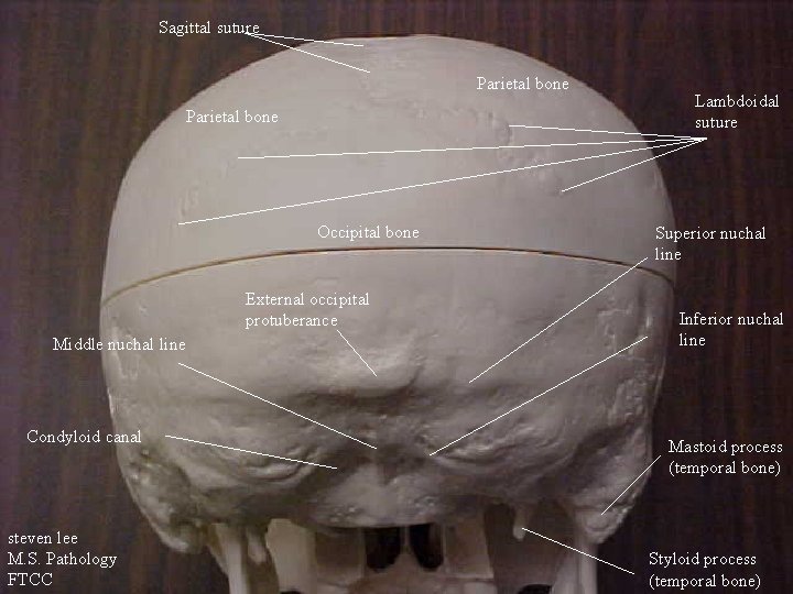 Sagittal suture Parietal bone Occipital bone External occipital protuberance Middle nuchal line Condyloid canal
