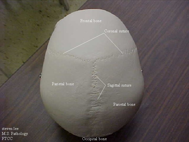 Frontal bone Coronal suture Parietal bone Sagittal suture Parietal bone steven lee M. S.