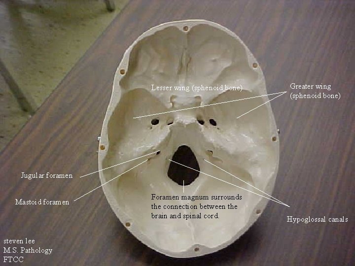 Lesser wing (sphenoid bone) Greater wing (sphenoid bone) Jugular foramen Mastoid foramen steven lee