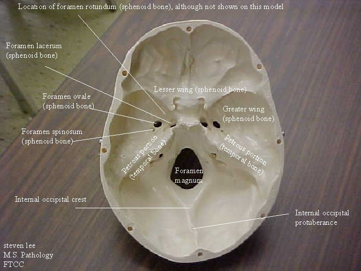 Location of foramen rotundum (sphenoid bone), although not shown on this model Foramen lacerum