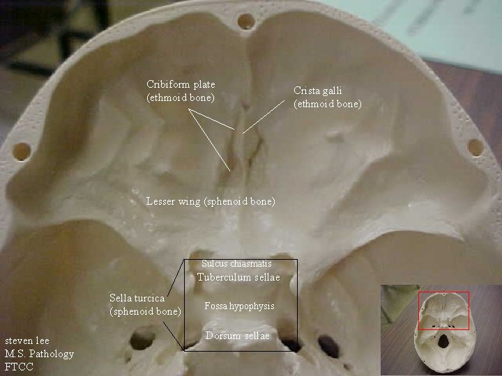 Cribiform plate (ethmoid bone) Lesser wing (sphenoid bone) Sulcus chiasmatis Tuberculum sellae Sella turcica