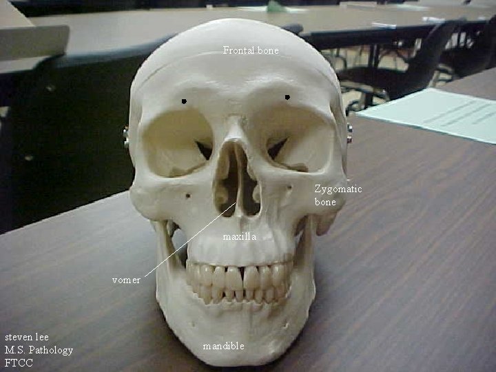 Frontal bone Zygomatic bone maxilla vomer steven lee M. S. Pathology FTCC mandible 