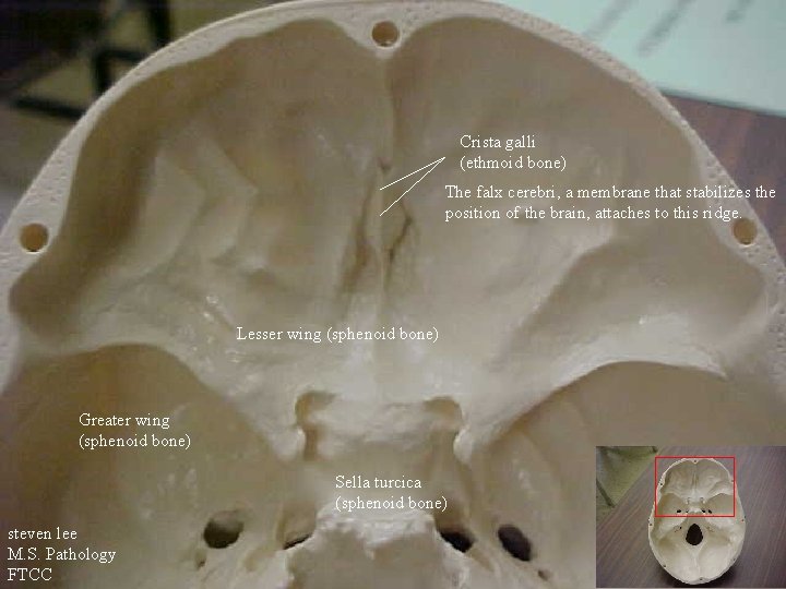 Crista galli (ethmoid bone) The falx cerebri, a membrane that stabilizes the position of