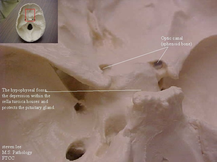 Optic canal (sphenoid bone) The hypophyseal fossa, the depression within the sella turcica houses