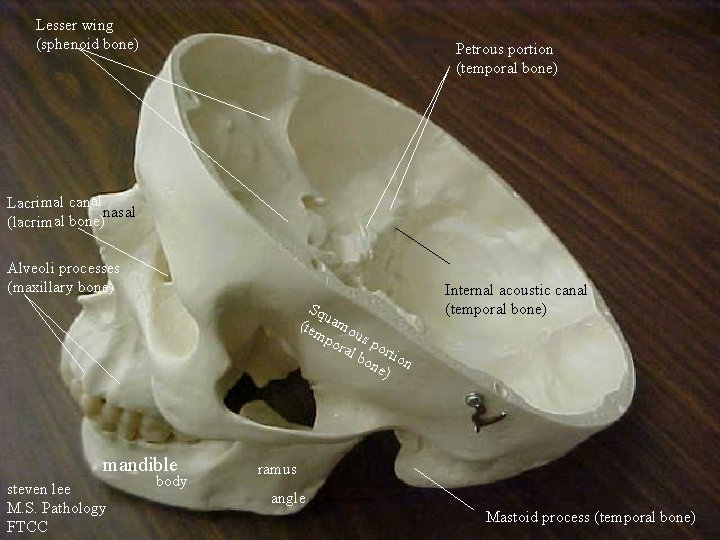Lesser wing (sphenoid bone) Petrous portion (temporal bone) Lacrimal canal nasal (lacrimal bone) Alveoli