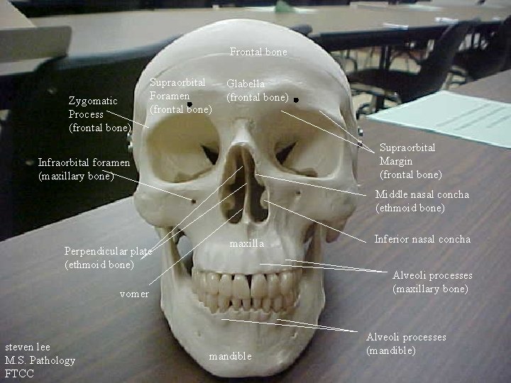 Frontal bone Zygomatic Process (frontal bone) Supraorbital Foramen (frontal bone) Glabella (frontal bone) Supraorbital